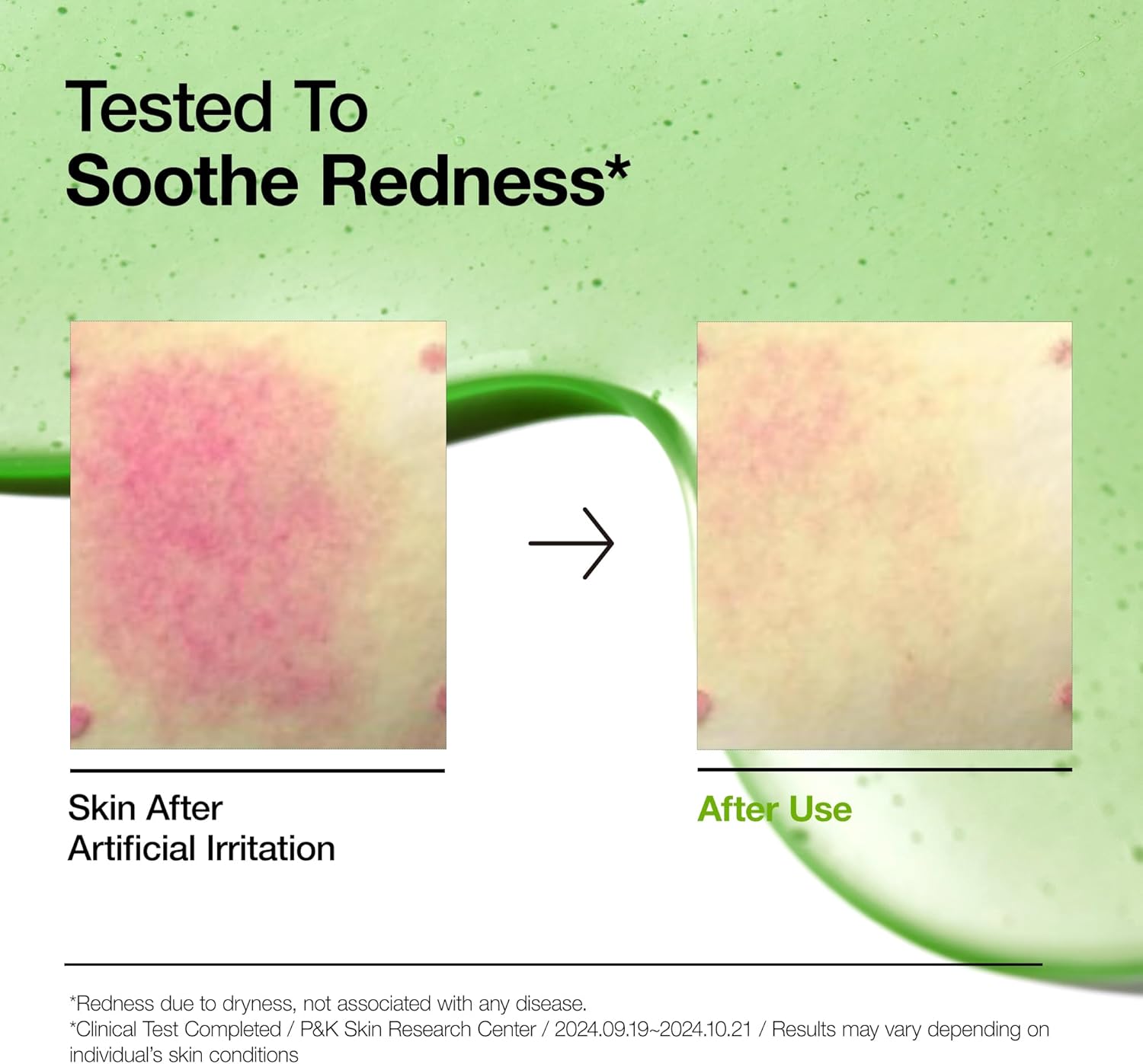 Azelaic Acid 10 Hyaluron Redness Soothing Serum, Facial Serum for Sensitive Skin, Hyaluronic Acid, Niacinamide, Spot Care, Natural Color, Vegan, Korean Skincare (30Ml/ 1.01 Fl Oz.)